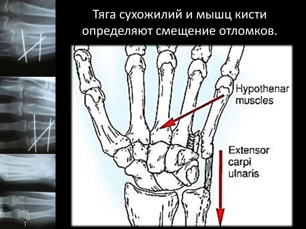 Перелом пястной кости карта вызова