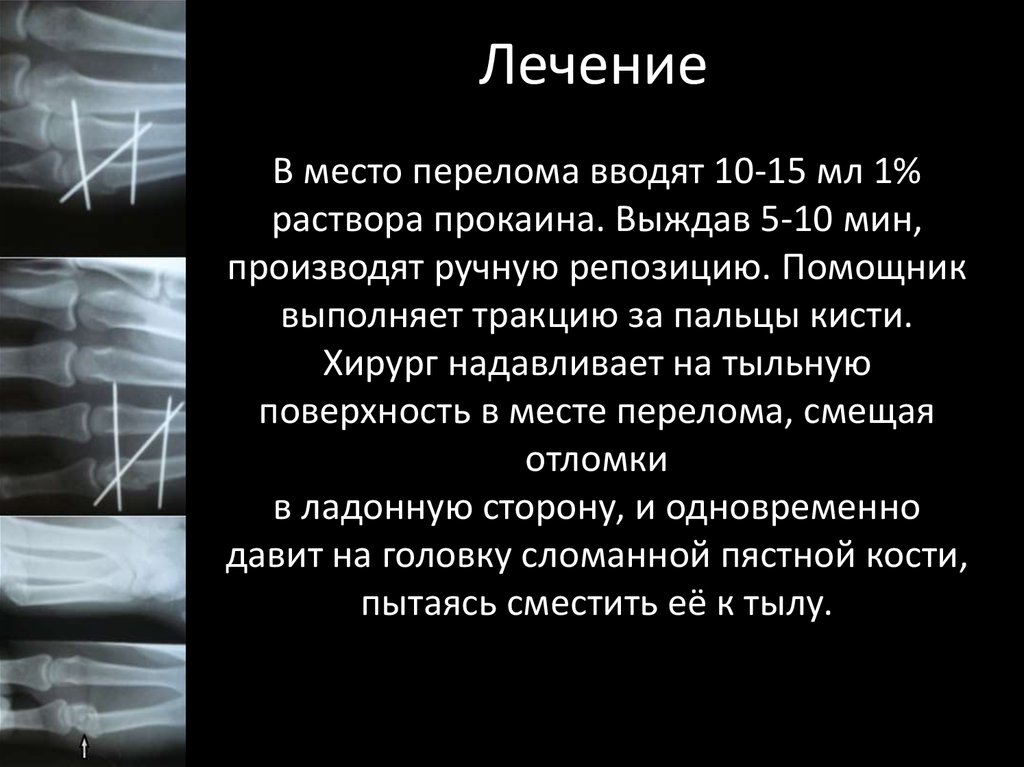 Перелом пястной кости карта вызова. Перелом пястной кости кисти код по мкб 10. Перелом 1 пястной кости код по мкб 10. Перелом 5 пястной кости код по мкб 10.