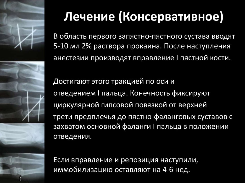 Лечение (Консервативное)