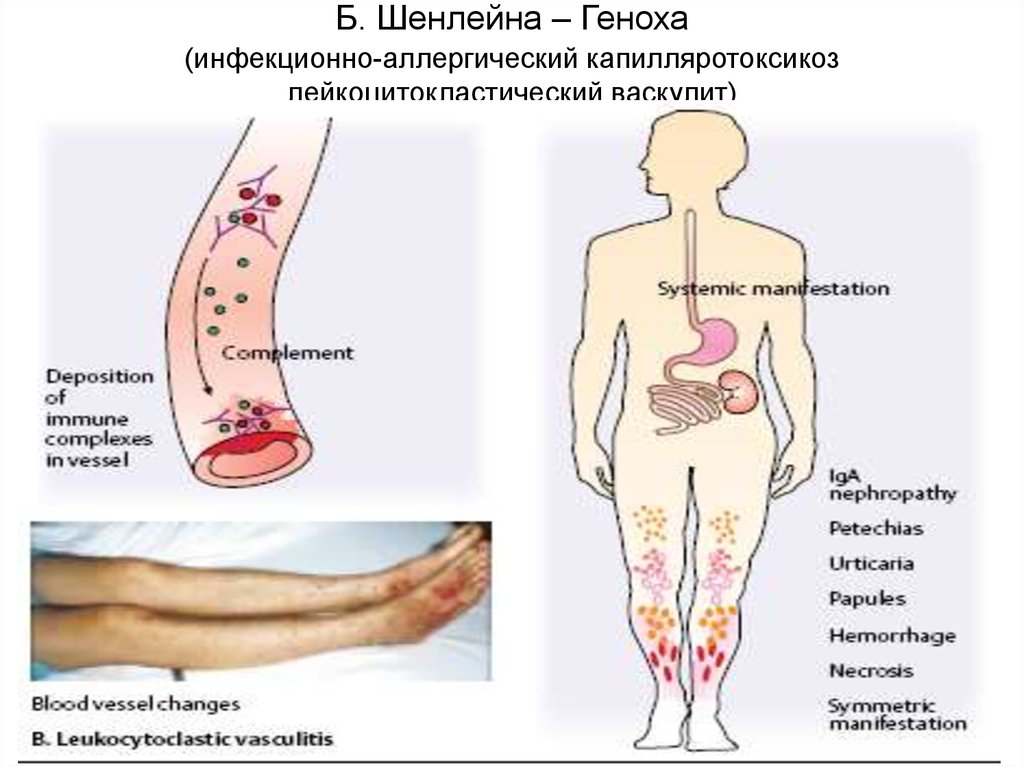 Vasculitis tratamiento natural