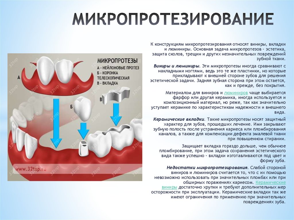 Презентация зубные вкладки