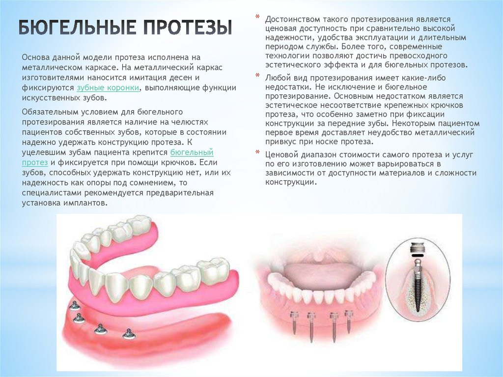 Как называется протезист. Бюгельный съемный протез показания. Бюгельный протез на 1 зуб верхней челюсти. Конструкция зубных протезов. Съемная конструкция для зубов.