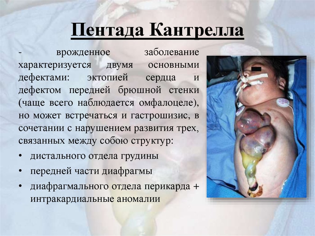 Пентада Кантрелла