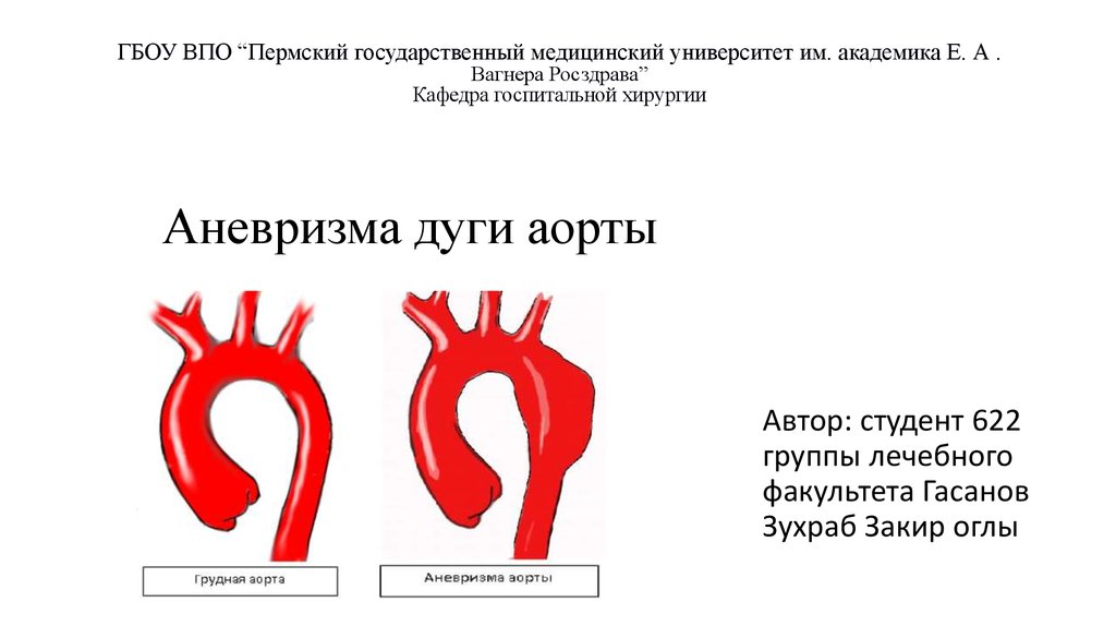 Презентация аневризма аорты