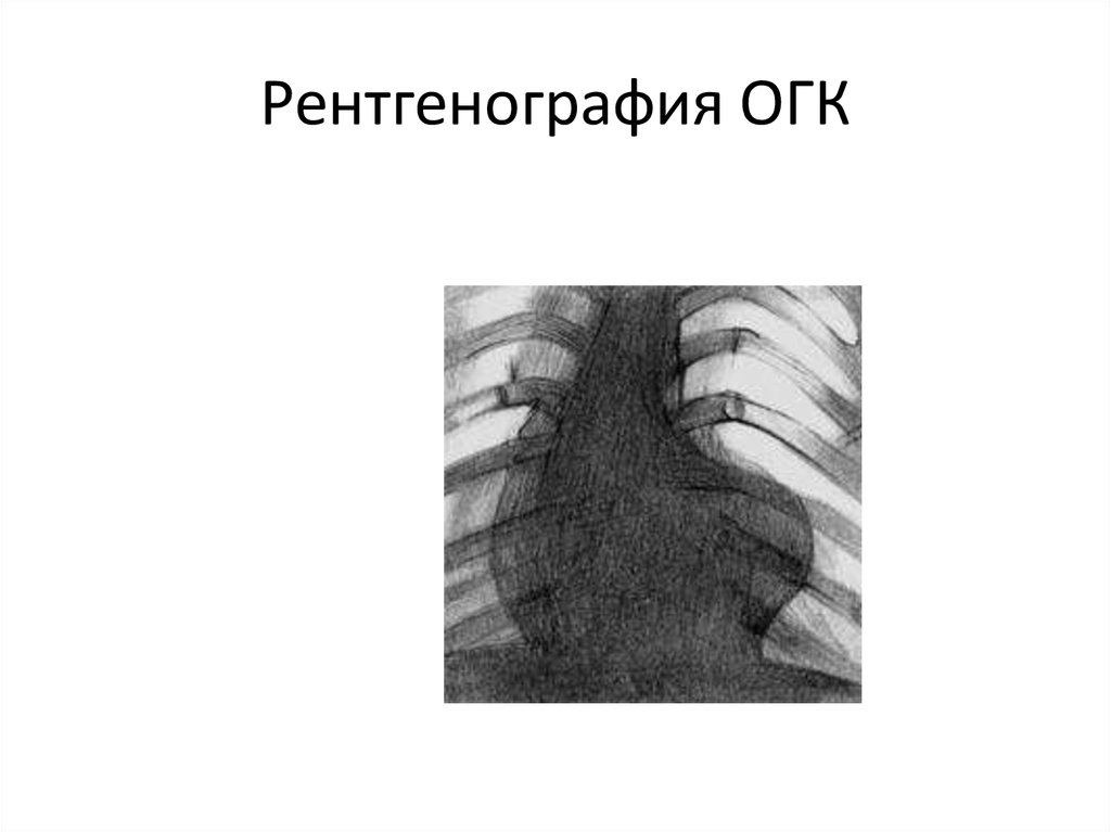 Огк это. Рентген ОГК норма. Рентгенография ОГК. Направление на рентген ОГК. Обзорная рентгенография ОГК направление.