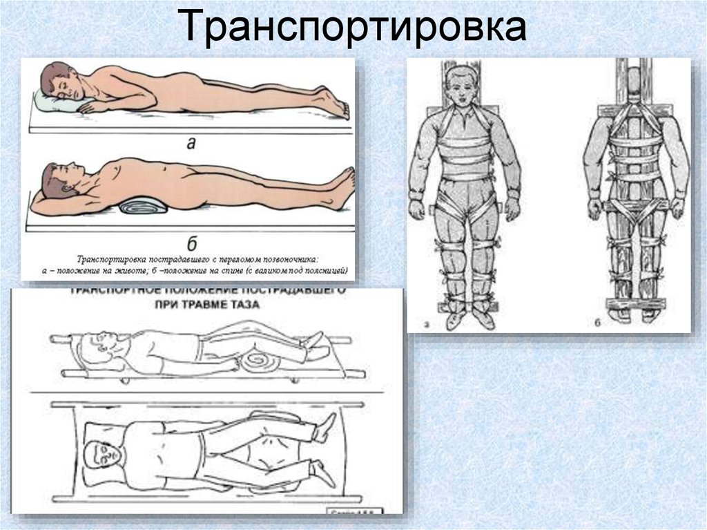 При повреждении позвоночника транспортируют