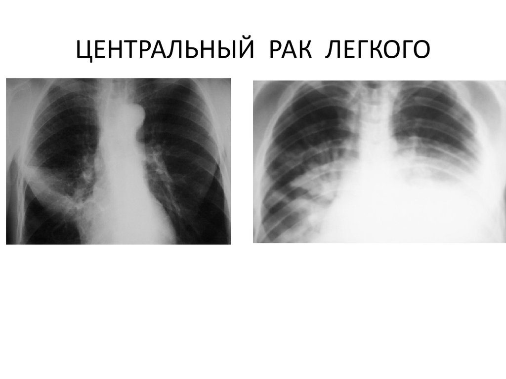 Центральный рак легкого. Раковое поражение легких. Центральные опухоли легких.