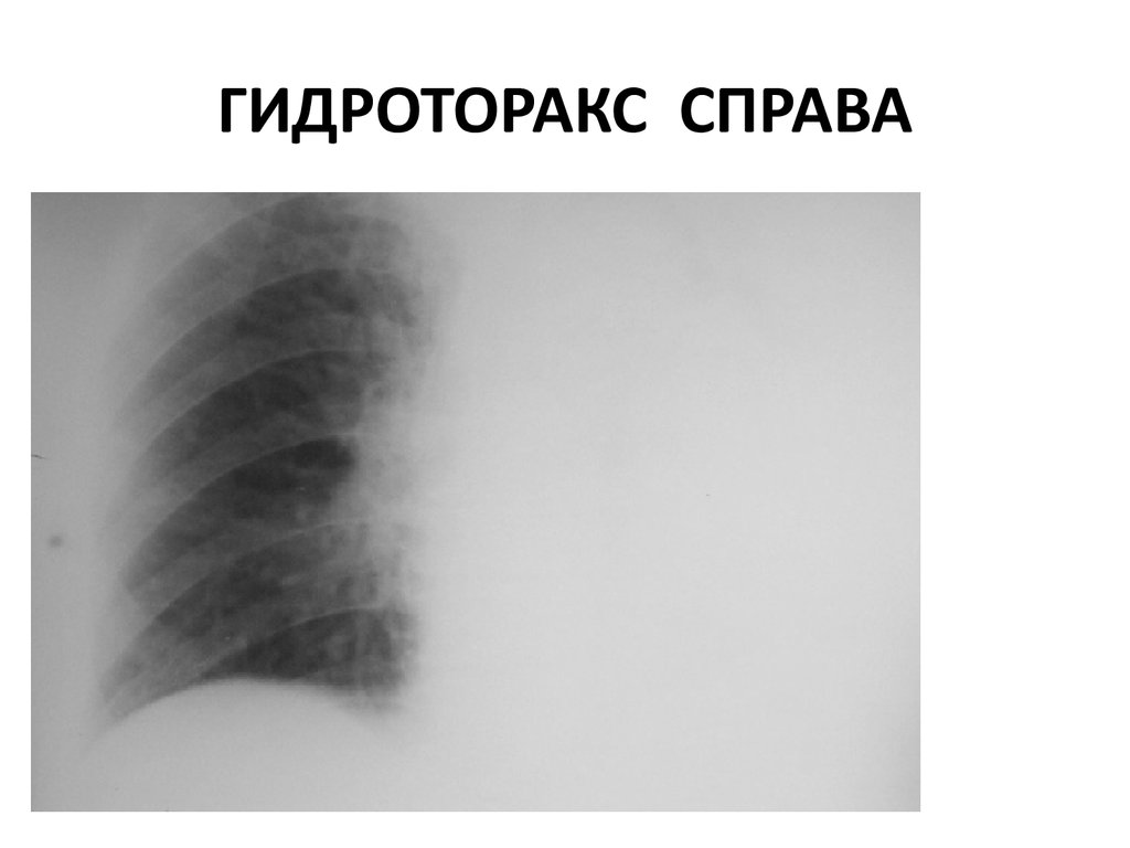 Признаки гидроторакса. Плащевидный гидроторакс. Тотальный левосторонний гидроторакс рентген. Правосторонний малый гидроторакс. Что такое левосторонний малый гидроторакс.