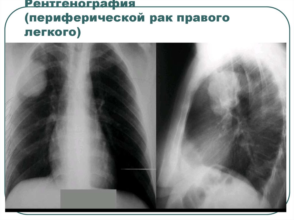 Как выглядит рак легких на рентгене фото у человека