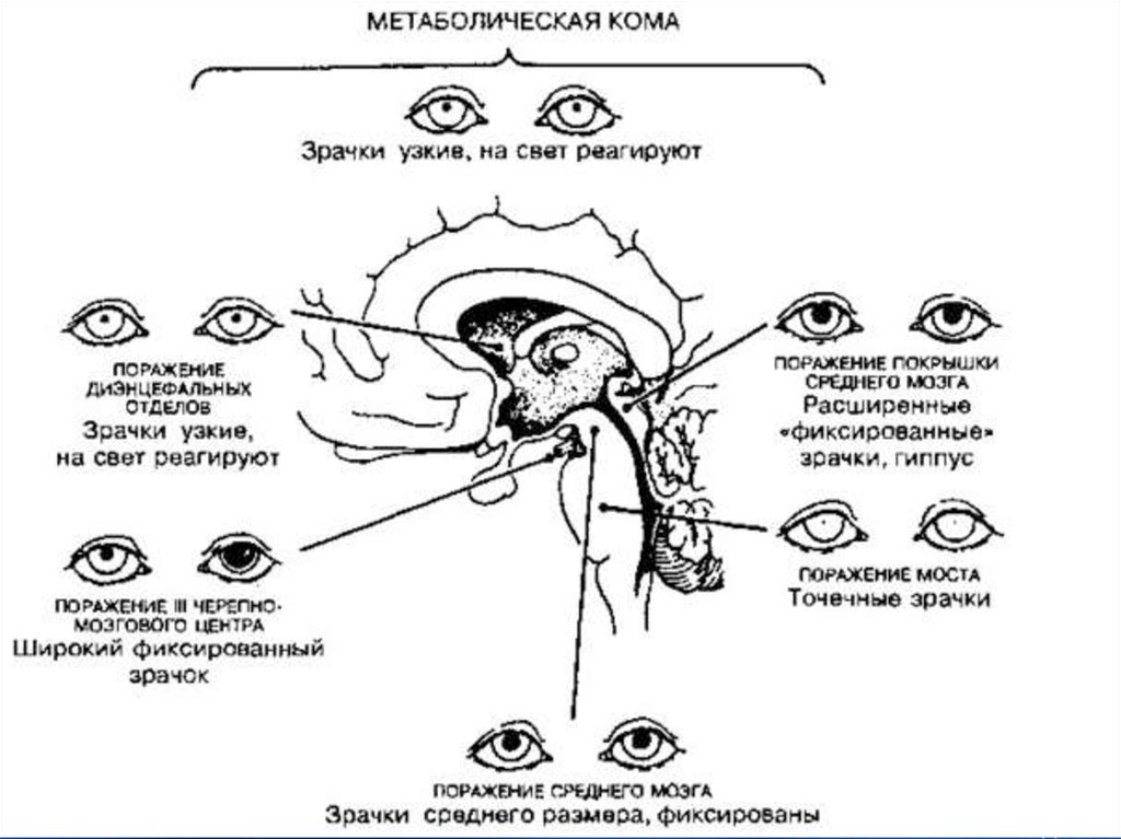 Отсутствие реакции зрачка на свет признак отсутствия. Зрачковый рефлекс при коме. Анизокория возникает при поражении какого отдела мозга. Зрачковые реакции в норме офтальмология. Зрачки не реагируют на свет при коме.