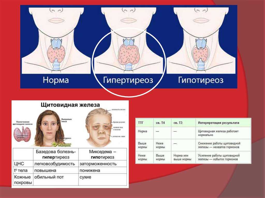 Операция щитовидной железы. Снижение работы щитовидной железы. Крупный узел и нормально  функционирующая щитовидка. Легковозбудимость это. Где лучше удалить щитовидную железу в Донецке ДНР.