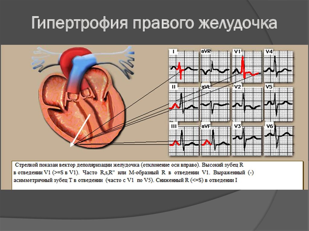 Миокард правого желудочка сердца. Гипертрофия левого желудочка на ЭКГ. Желудочковая гипертрофия ЭКГ. Гипертрофия желудочка сердца на ЭКГ. ЭКГ синдром гипертрофии желудочков.