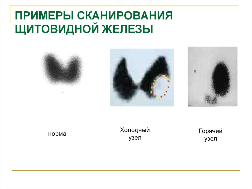 Сцинтиграфия щитовидной железы это