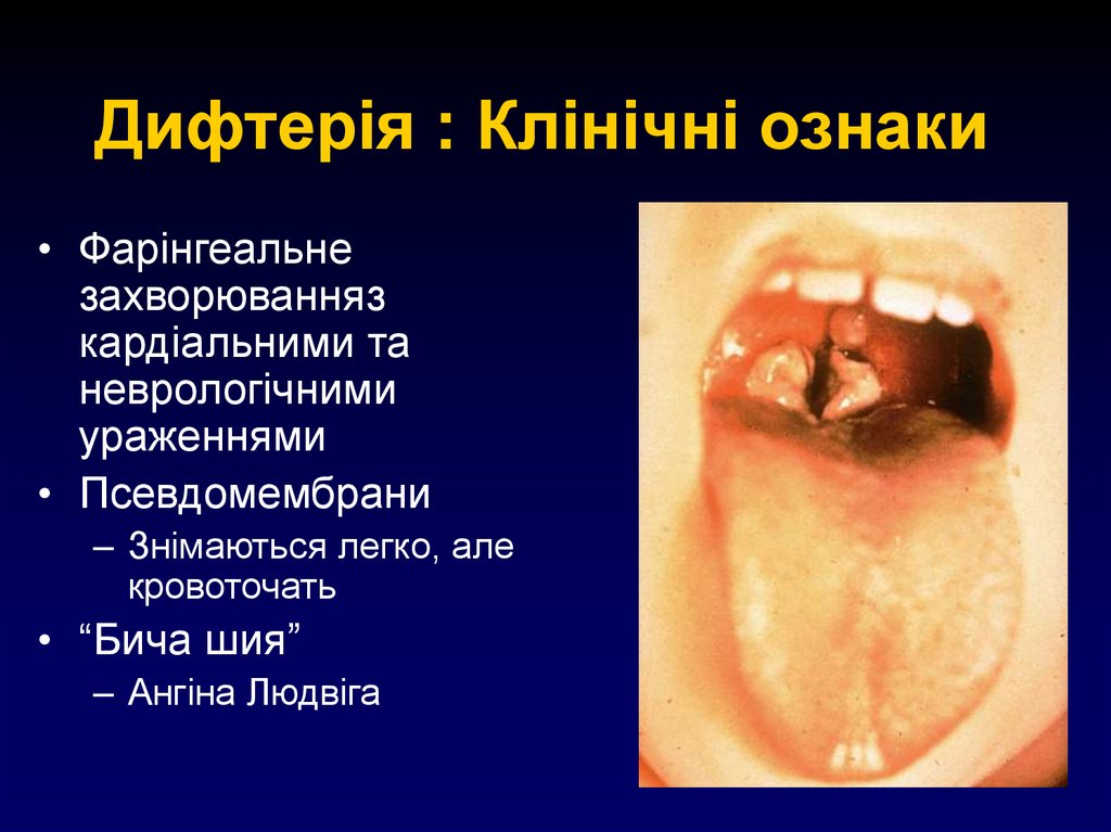 Дифтерія : Клінічні ознаки