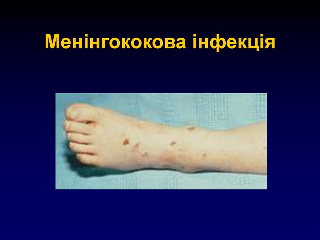 Менінгококова інфекція