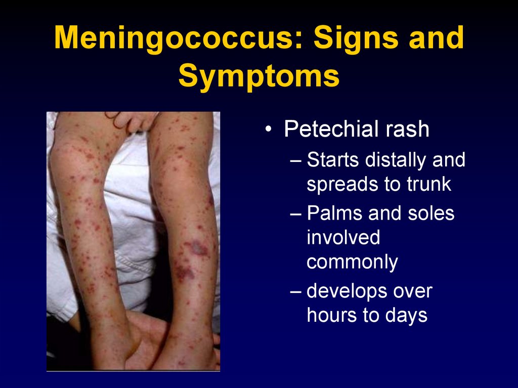 Meningococcus: Signs and Symptoms