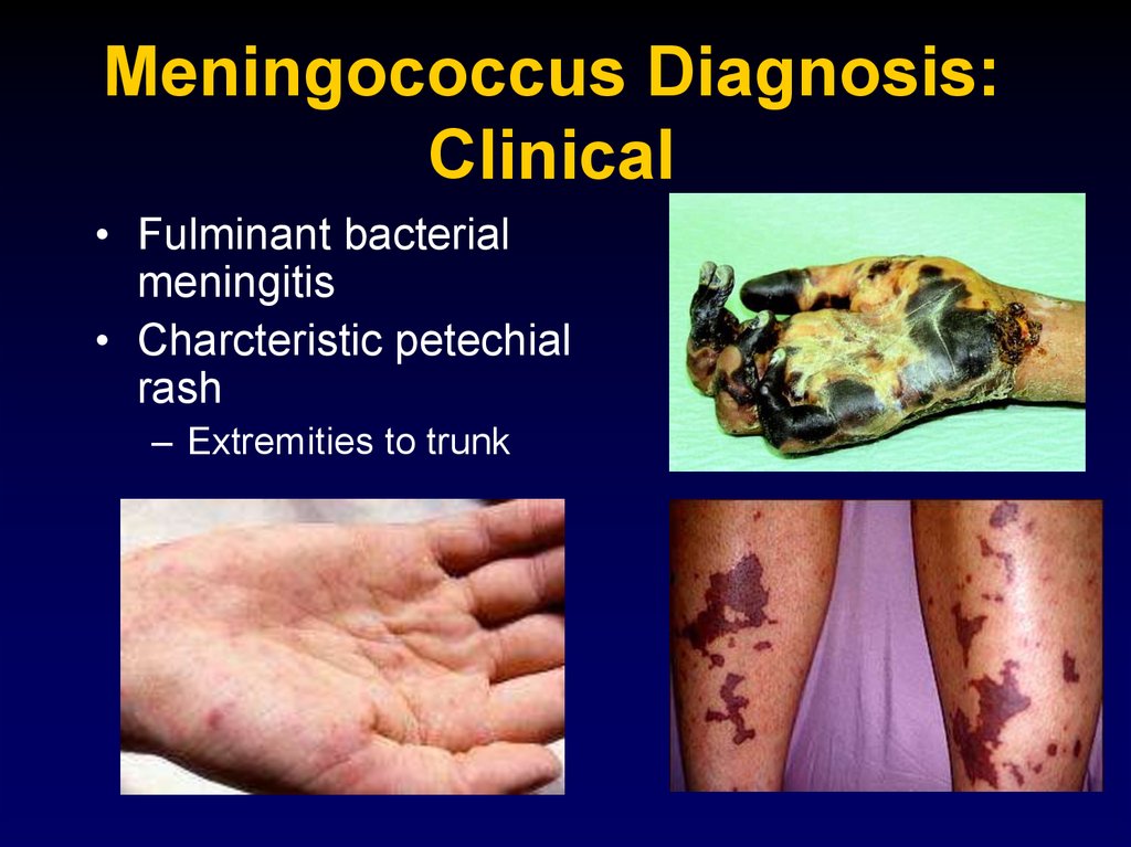 Meningococcus Diagnosis: Clinical