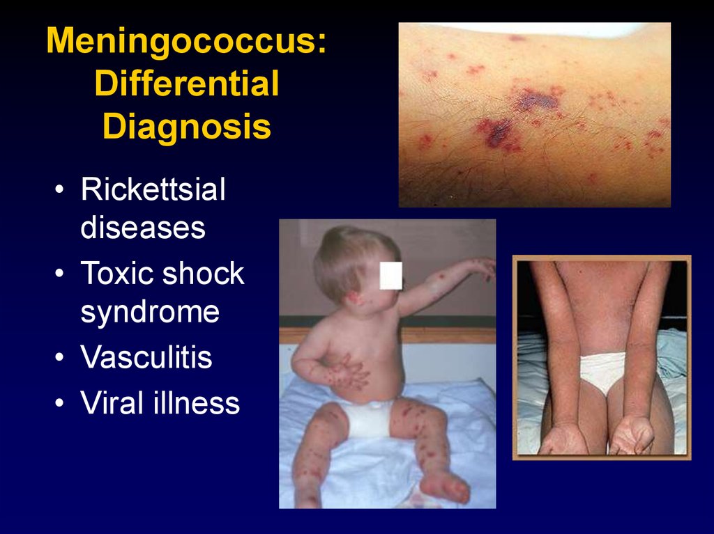 Meningococcus: Differential Diagnosis