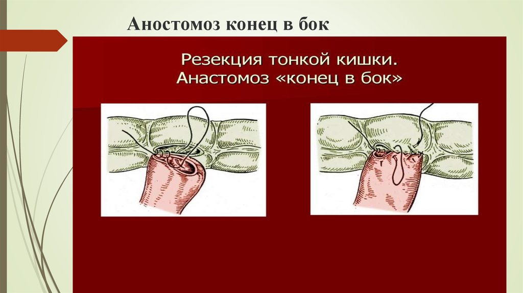 Аностомоз конец в бок