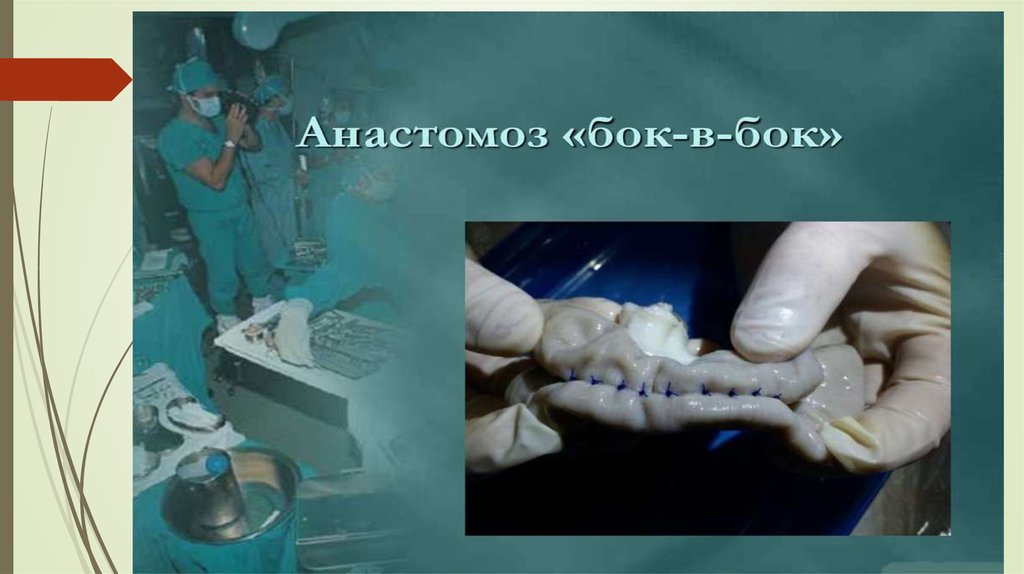 Аностомоз бок в бок