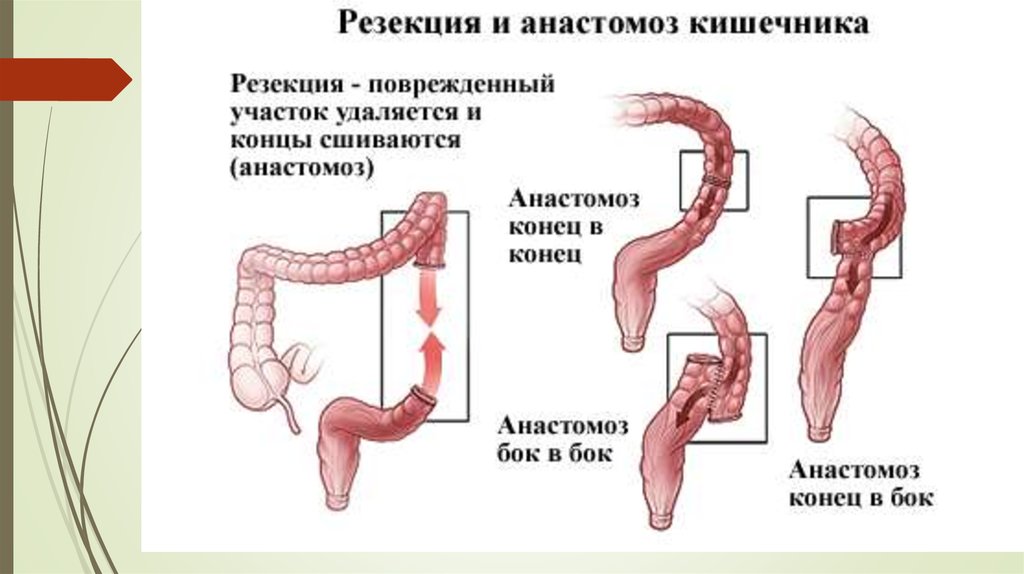 Анастомоз конец в конец схема