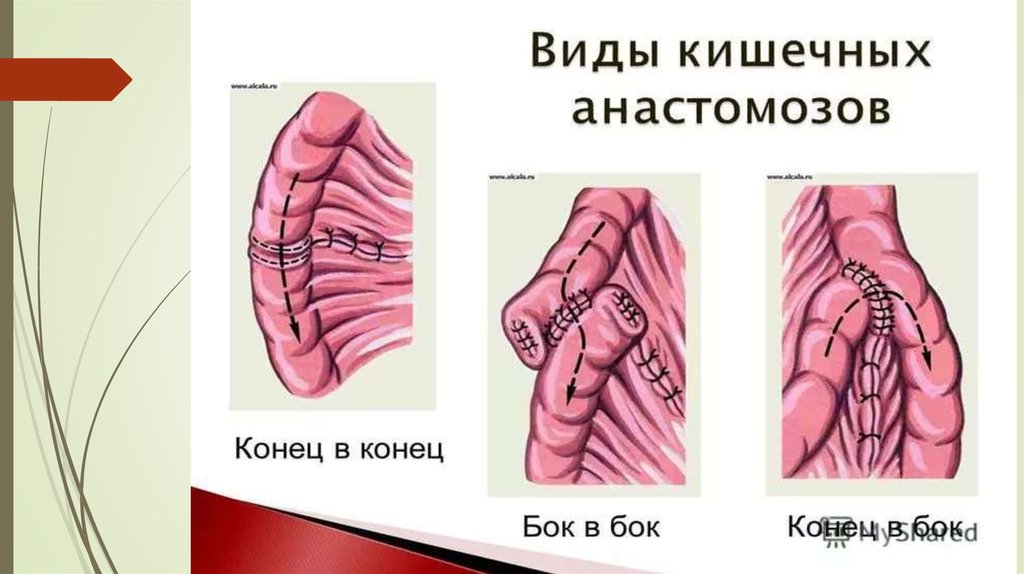 Соединение тканей топографическая анатомия. Анастомоз тонкой кишки. Анастомоз кишечника конец в конец. Кишечные анастомозы топографическая анатомия. Конец в бок межкишечный анастомоз.