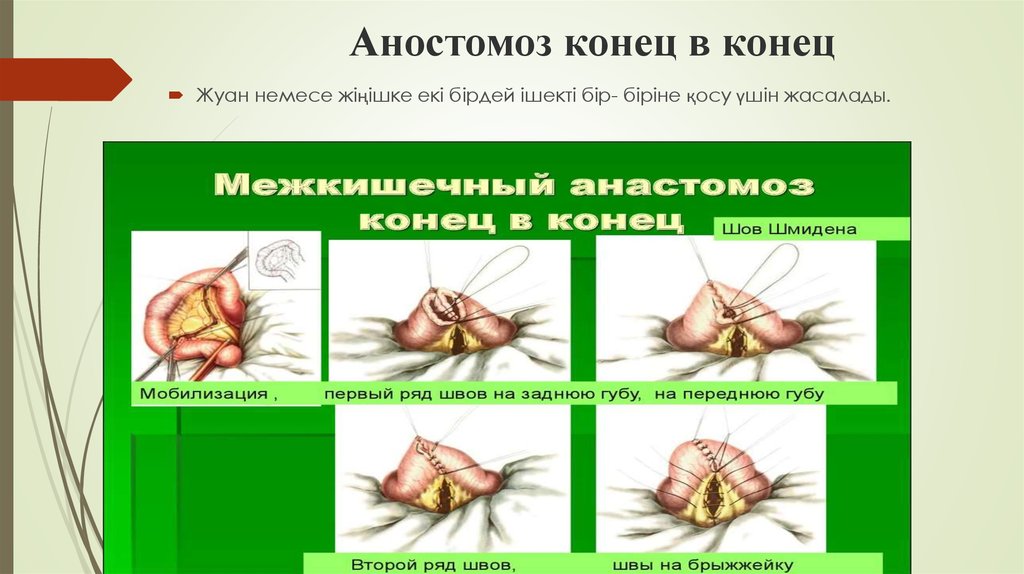 Аностомоз конец в конец