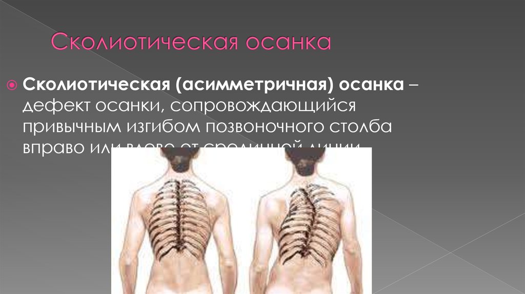 Сколиотическая осанка