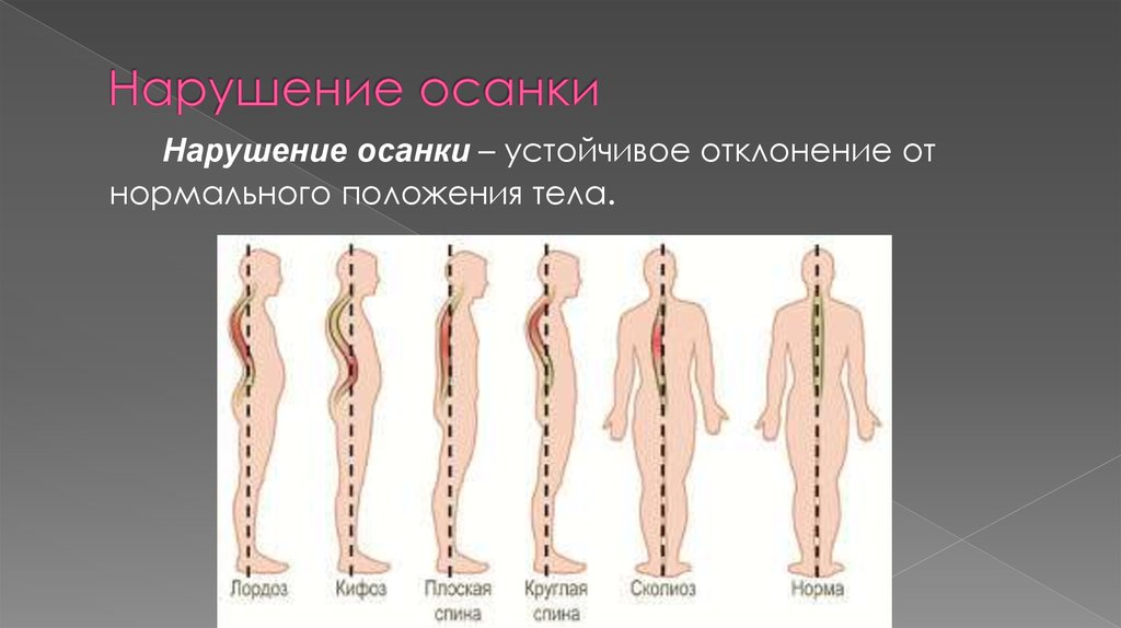 Рассмотрите рисунки 1 4 с изображением типов осанок человека как называют нарушение осанки