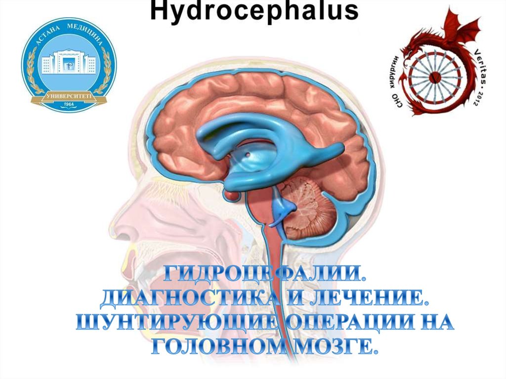 Гидроцефалия шунтирование мозга. Операции при гидроцефалии.