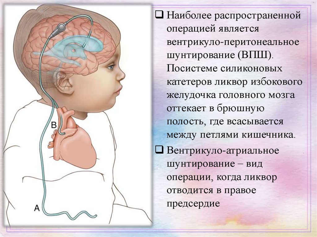 Диагноз гидроцефалии. Вентрикулоперитонеальный шунт схема. Шунтирование гидроцефалии головного. Шунтирующие операции при гидроцефалии.