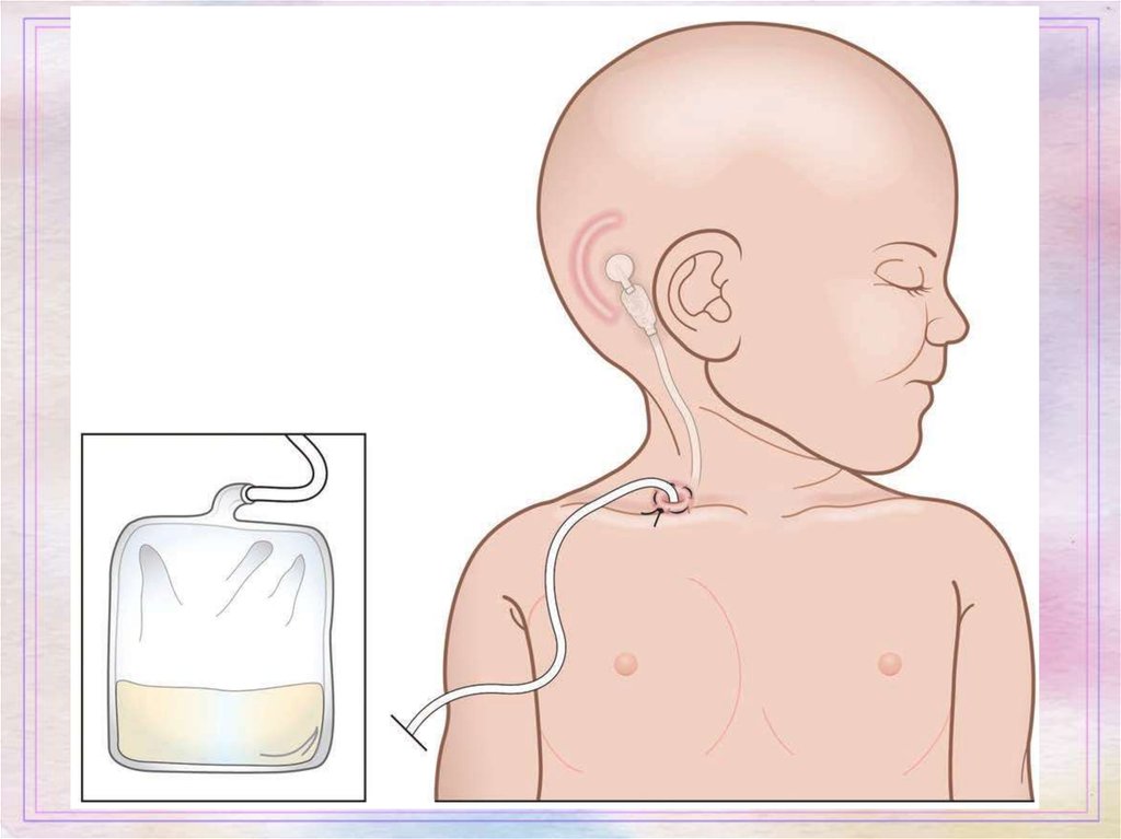 Шунты в уши ребенку. Шунт головного мозга при гидроцефалии. Программируемый шунт при гидроцефалии. Гидроцефалия шунтирование. Шунтирование головного мозга новорожденного.