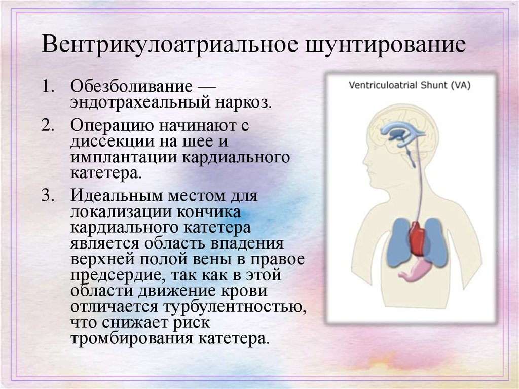 Шунт головного мозга. Вентрикулоперитонеальный шунт схема. Вентрикулоатриальный шунт. Шунтирующая операция гидроцефалия. Вентрикуло-перитонеальное шунтирование головного мозга.