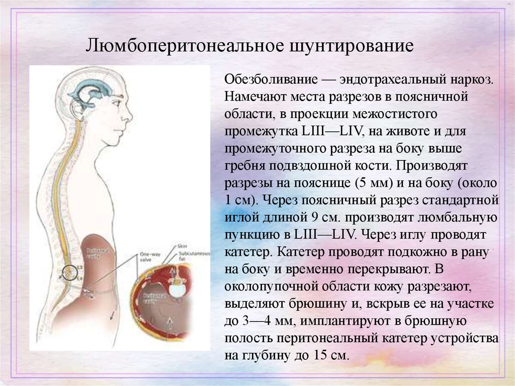 Шунтирование мозга