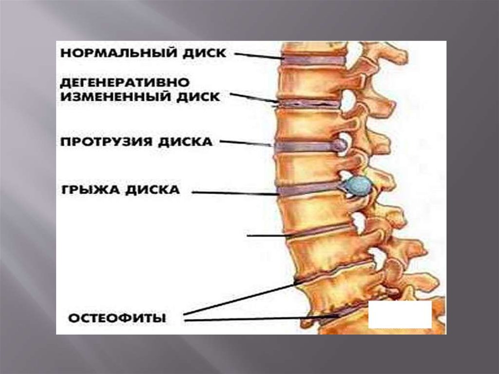 Поясничные диски. Протрузия дисков позвоночника. Дегенеративно измененный диск. Протрузия l4-5.