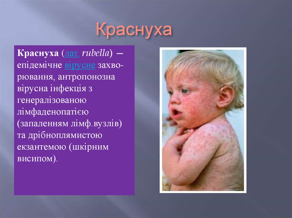 Епідемічне вірусне захворювання краснуха - презентация онлайн