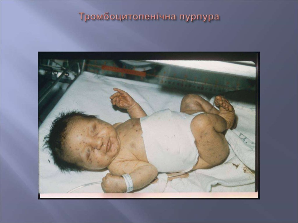 Тромбоцитопенічна пурпура