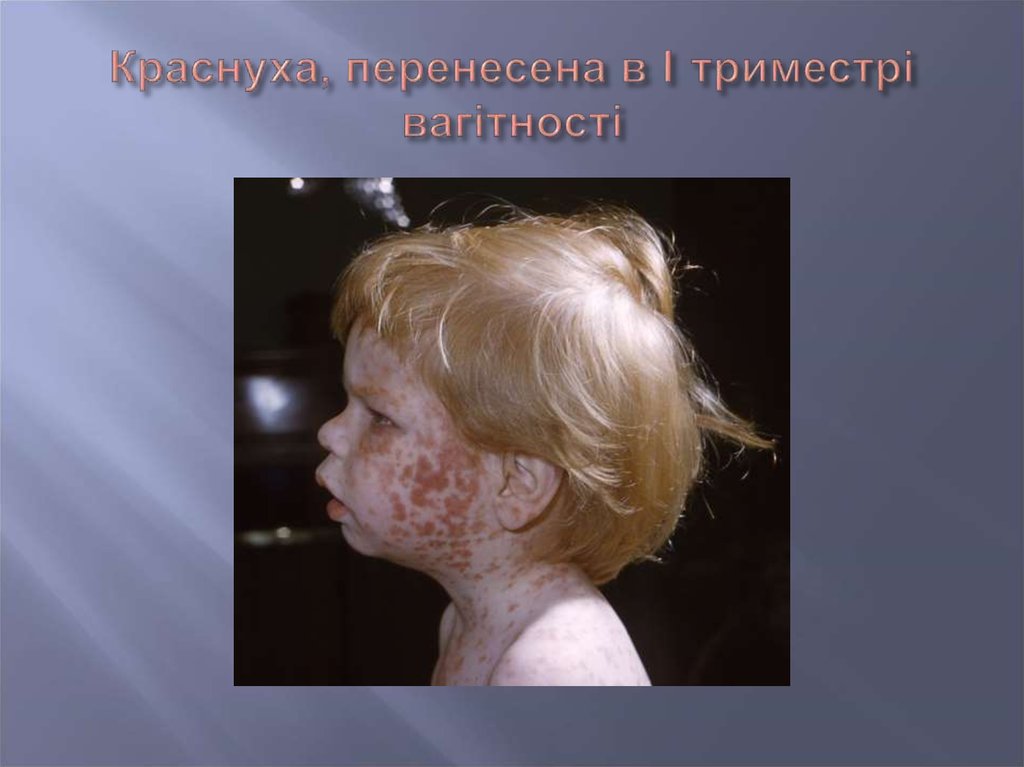 Краснуха, перенесена в I триместрі вагітності