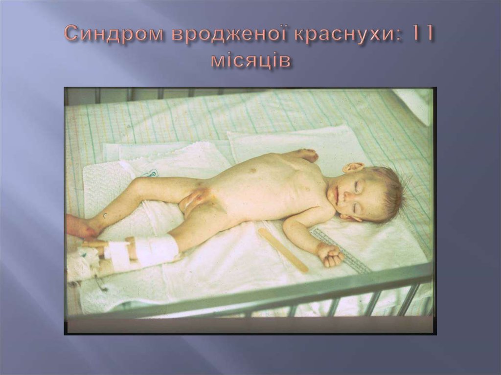 Синдром вродженої краснухи: 11 місяців