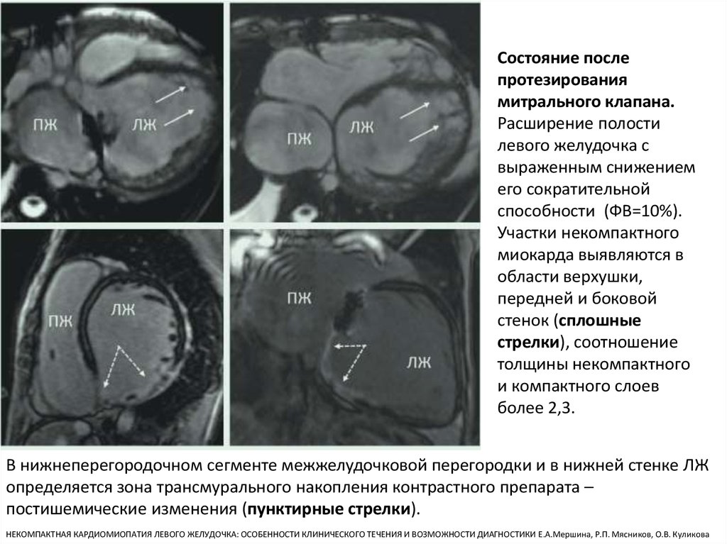 Увеличение лев желудочка