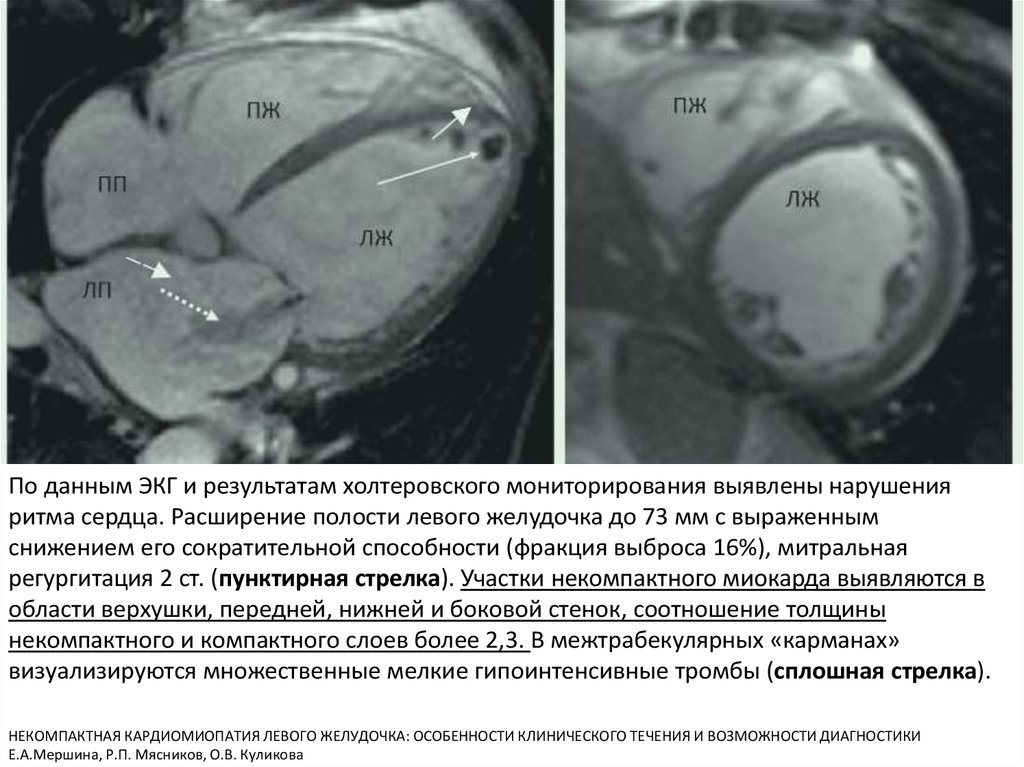 Нарушение миокарда желудочка. Некомпактный миокард мрт. Некомпактный миокард левого желудочка мрт. Критерии некомпактного миокарда мрт. Некомпактный миокард левого желудочка рентген.