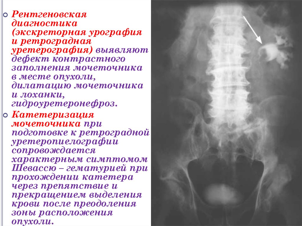 Экскреторная урография презентация