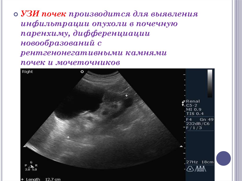 Ультразвуковое узи почек. Ультразвуковое исследование почек конкременты. Дифференцировка почечной паренхимы УЗИ. Микронефролитиаз почек УЗИ.