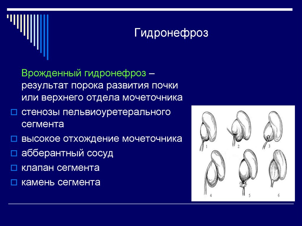 Гидронефроз клиническая картина