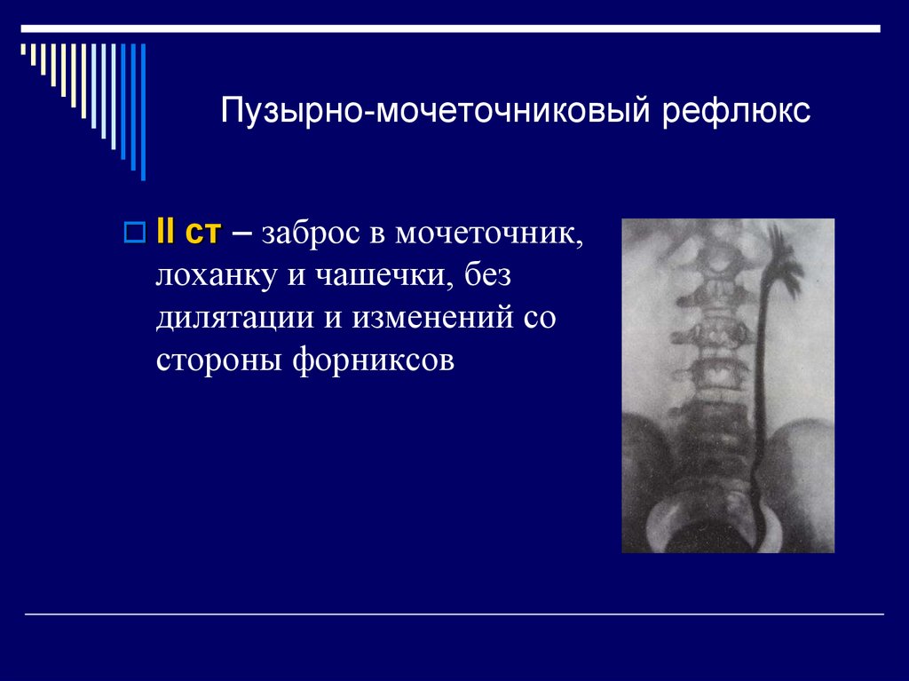 Пузырно мочеточниковый рефлюкс презентация