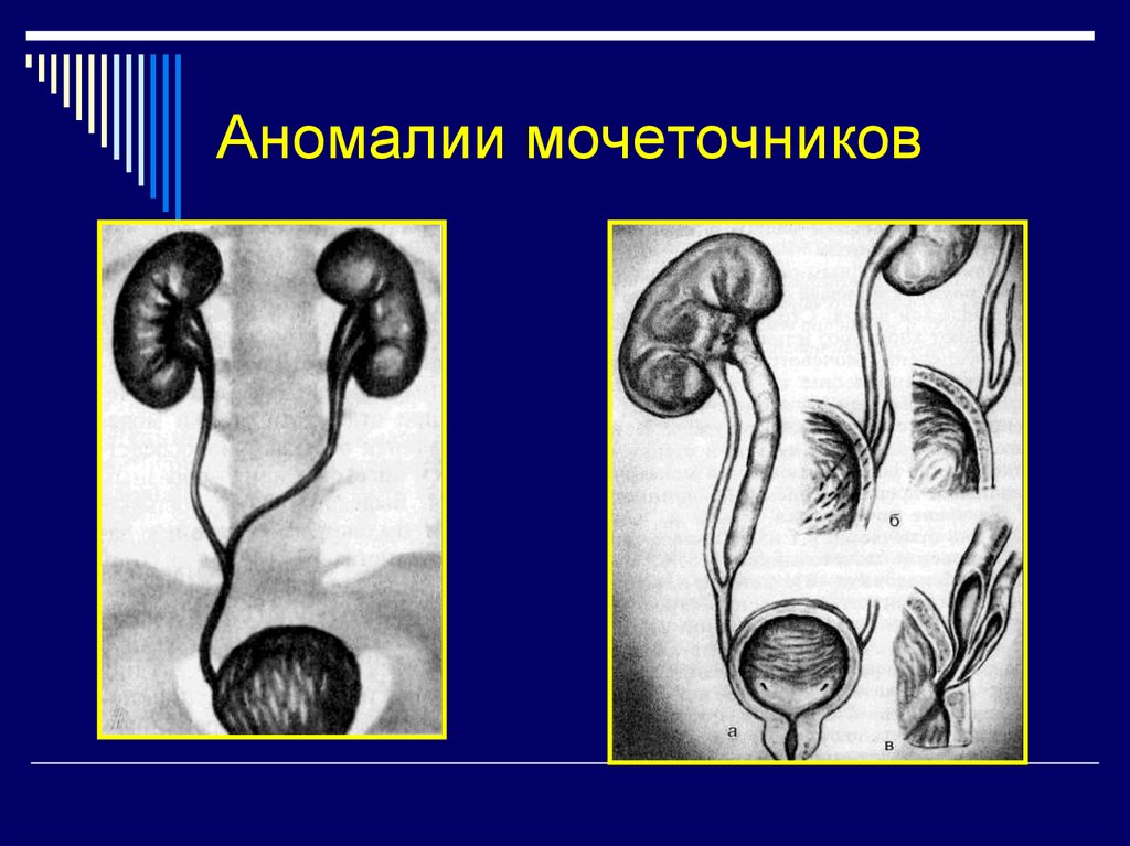 Развитие мочеточников. Врожденные аномалии мочеточников. Пороки развития почек и мочеточников. Аномалии формы мочеточника. Аномалии развития мочеточников и мочевого пузыря.