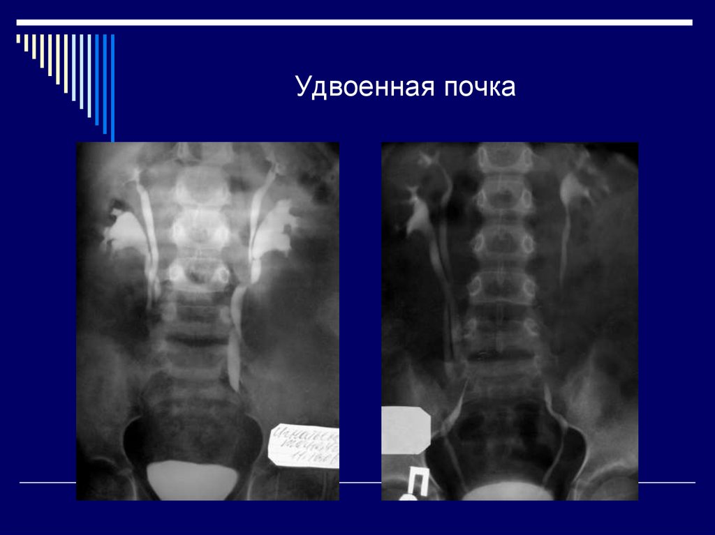 Удвоенная почка у взрослого фото