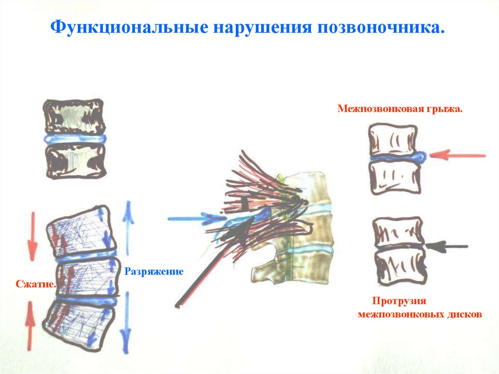 Нарушение позвоночника. Нарушения позвоночника. Межпозвоночный диск нарушения. Функциональные нарушения позвоночника. Протрузия сжатие нерва.