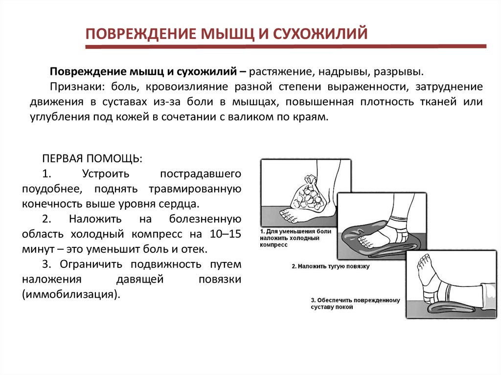 Разрыв мышц признаки