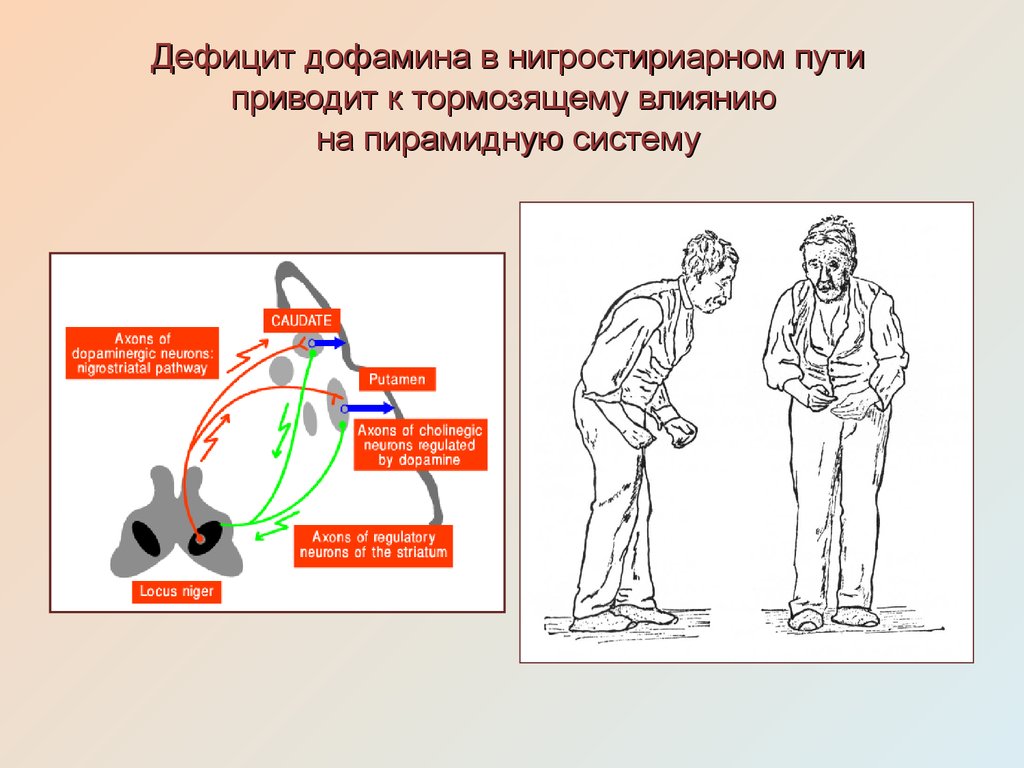 Тормозящее действие. Недостаток дофамина. Недостаток дофамина симптомы. Признаки недостатка дофамина. Избыток дофамина.